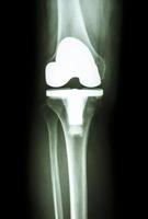 protesi articolare del ginocchio articolazione artificiale del paziente artrosi foto
