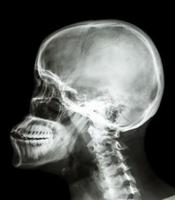 La vista laterale del cranio dei raggi x della pellicola mostra il cranio umano e la colonna cervicale foto