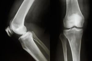 pellicola a raggi x mostra normale articolazione del ginocchio ap laterale foto