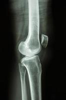 la vista laterale del ginocchio a raggi x del film mostra l'articolazione del ginocchio umano normale