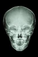 film a raggi x cranio vista ap mostra normale teschio di bambino tailandese s