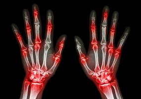 film a raggi X sia le mani umane che l'artrite a gotta articolare multipla, reumatoide foto