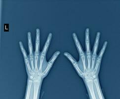 raggi X tutti e due mani su bianca sfondo medico Immagine concetto. foto