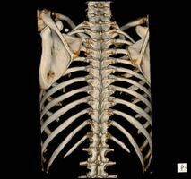 raggi X e ct scansione toracica colonna vertebrale foto