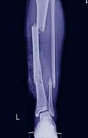 film raggi X multiplo frattura gamba tibia e fibulare foto