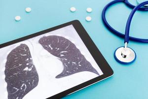 computer tablet con radiografia polmonare e stetoscopio e pillole su sfondo blu. concetto di malattie polmonari