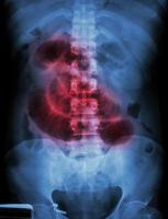 pellicola di ostruzione dell'intestino tenue radiografia dell'addome in posizione supina mostra intestino tenue dilatato