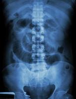 pellicola di ostruzione dell'intestino tenue radiografia dell'addome in posizione supina mostra intestino tenue dilatato foto