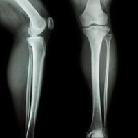 pellicola radiografica gamba e ginocchio vista ap antero-posteriore - laterale foto