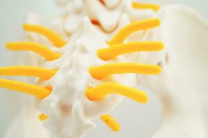spinale nervo e osso, lombare colonna vertebrale sfollati ernia disco frammento, modello per trattamento med foto