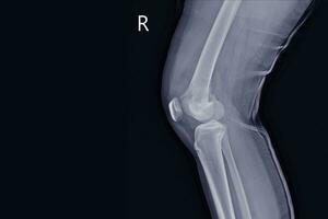 raggi X ginocchio aderire un' femmina 15 anno vecchio mostrando grande osteolitico lesione di mediano aspetto di giusto distale femore.con morbido tessuto massa.e maligno osso tumore, osteosarcoma è sospettato. foto