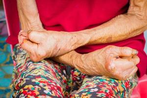 mani del primo piano della donna anziana che soffre di lebbra, mani amputate. foto