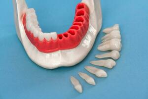 denti impiantare e corona installazione processi parti isolato su un' blu sfondo. medico preciso 3d modello. foto