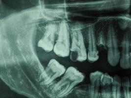 raggi x dei denti umani foto