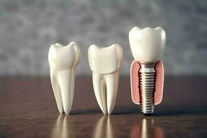 vicino su di un' dentale dente impiantare o salutare umano denti. bianca smalto e dentale impianti chirurgia concetto di ai generato foto