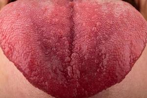 crepe nelle malattie da candida della lingua, primo piano della stomatite della lingua rossa. foto