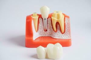 dentale impiantare, artificiale dente radici in mascella, radice canale di dentale trattamento, gomma patologia, denti modello per dentista studiando di odontoiatria. foto