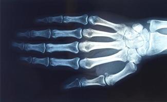 radiografia della mano foto