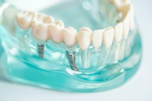 dentale impiantare, artificiale dente radici in mascella, radice canale di dentale trattamento, gomma patologia, denti modello per dentista studiando di odontoiatria. foto