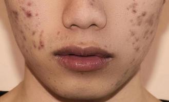 primo piano di acne sulla pelle, acne sul viso causata da ormoni. foto