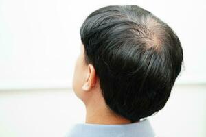 Calvo testa nel uomo, capelli perdita trattamento Salute problema. foto