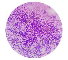 usg guidato fna citologia di fegato sol mostrando non Hodgkin linfoma. metastatico carcinoma foto