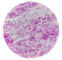 microfotografia di pap sbavatura mostrando infiammatorio sbavatura con HPV relazionato i cambiamenti. cervicale cancro. scc foto