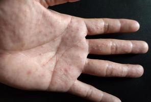 L'eczema disidrotico è una condizione allergica della pelle. foto
