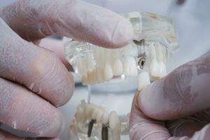 il ortodontista detiene un' modello di denti con impianti nel il suo mano e Spettacoli Come per inserire il dente. vicino su. macro foto