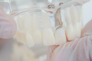 il ortodontista detiene un' modello di denti con impianti nel il suo mano e Spettacoli Come per inserire il dente. vicino su. macro foto