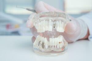 medico ortodontista detiene nel il suo mano un' modello di denti con impianti foto