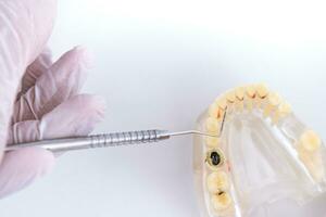 medico ortodontista Spettacoli il strumento su carie nel il denti foto