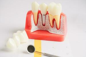 dentale impiantare, artificiale dente radici in mascella, radice canale di dentale trattamento, gomma patologia, denti modello per dentista studiando di odontoiatria. foto