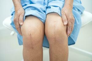 asiatico anziano donna paziente mostrare sua cicatrici chirurgico totale ginocchio comune sostituzione suturare ferita chirurgia artroplastica su letto nel Ospedale. foto