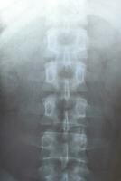 X raggio di il lombare colonna vertebrale, colonna vertebrale su raggi X foto