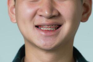 asiatico uomo bretelle. denti bretelle su il bianca denti di uomo per pareggiare il denti. supporto sistema nel sorridente bocca, vicino su foto denti, macro sparo, dentista Salute concetto.
