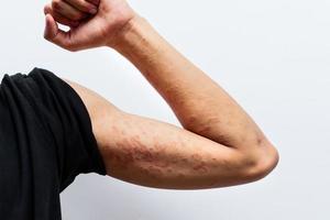 dermatite ravvicinata sulla mano dell'uomo, dermatite allergica cutanea eczema della pelle di un paziente. dermatite atopica sintomo dettaglio pelle texture, fungo della pelle. il concetto di dermatologia. foto