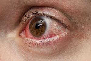 rosso occhio di un' paziente con congiuntivite, vicino su foto