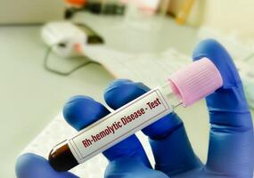 emolitico rh fattore test anche conosciuto come rh incompatibilità o rh-emolitico malattia test. foto