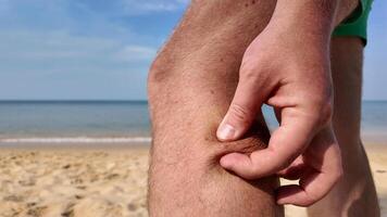 sulla spiaggia corpo consapevolezza, pizzicare coscia, spiaggia volare morsi, spiaggia Pulce morsi foto