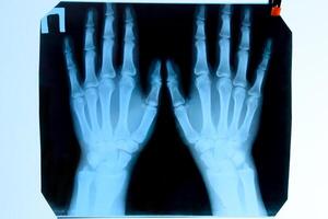 X raggio di il mani, un' immagine di il ossatura di il mani su il raggi X. foto