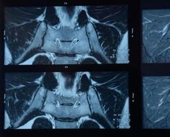 mri sacroiliaco articolazione. studia di anchilosante spondiloartrite paziente. foto