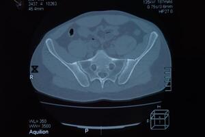 mri sacroiliaco articolazione. studia di anchilosante spondiloartrite paziente. foto