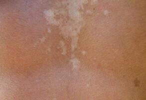 scottatura su il pelle di il Indietro. esfoliazione, pelle bucce spento. pericoloso sole abbronzatura foto