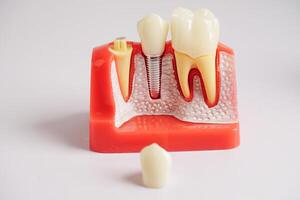 dentale impiantare, artificiale dente radici in mascella, radice canale di dentale trattamento, gomma patologia, denti modello per dentista studiando di odontoiatria. foto