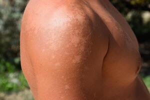 scottatura su il pelle di il le spalle. esfoliazione, pelle bucce spento. pericoloso sole abbronzatura foto