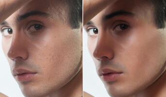 prima e dopo cosmetico operazione. giovane uomo ritratto foto