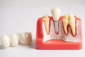 dentale impiantare, artificiale dente radici in mascella, radice canale di dentale trattamento, gomma patologia, denti modello per dentista studiando di odontoiatria. foto