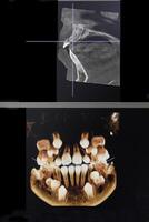 ct Immagine di il denti di un' 9 anni bambino, con bambino denti, nel diverso proiezioni. cbct di Due mascelle. foto