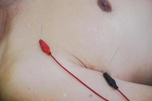 avvicinamento aghi su paziente corpo stimolato di elettrico. agopuntura, Cinese alternativa medicinale. foto
